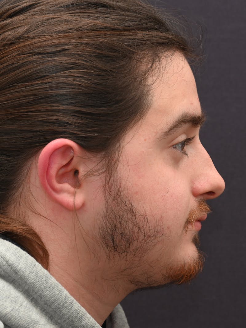 Rhinoplasty Before & After Gallery - Patient 172696 - Image 1