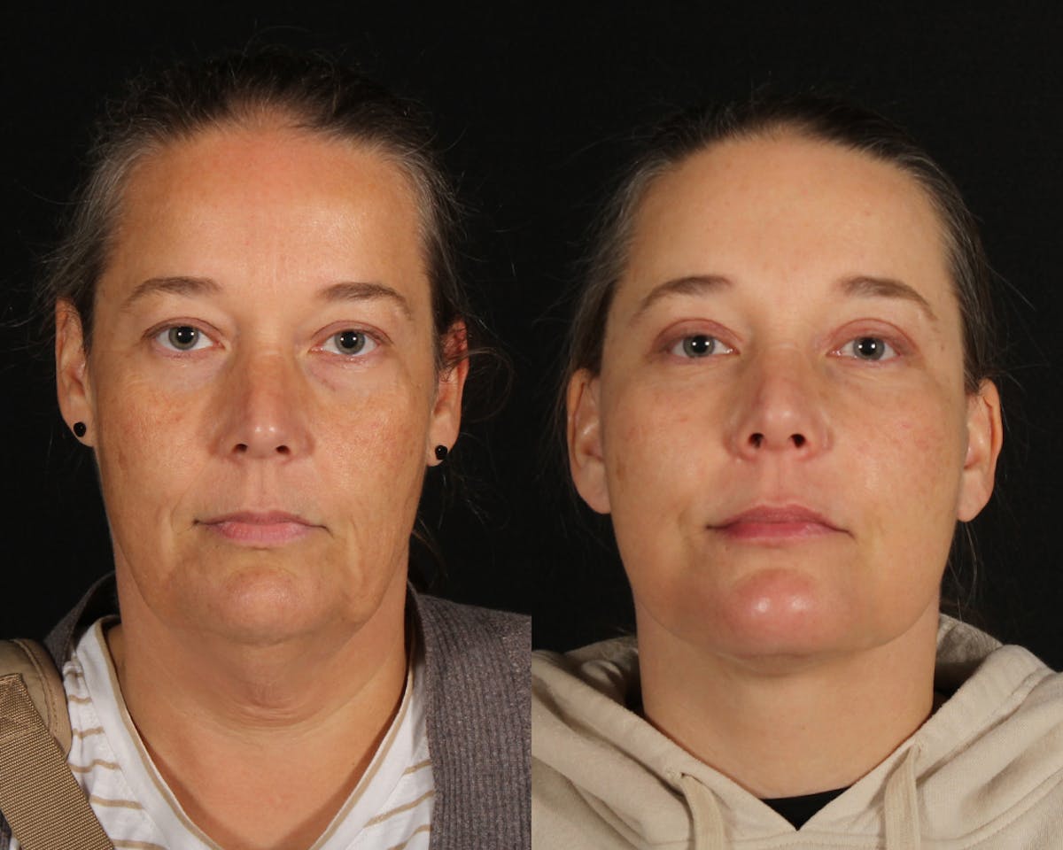 Face & Neck Lift Before & After Gallery - Patient 106284 - Image 1