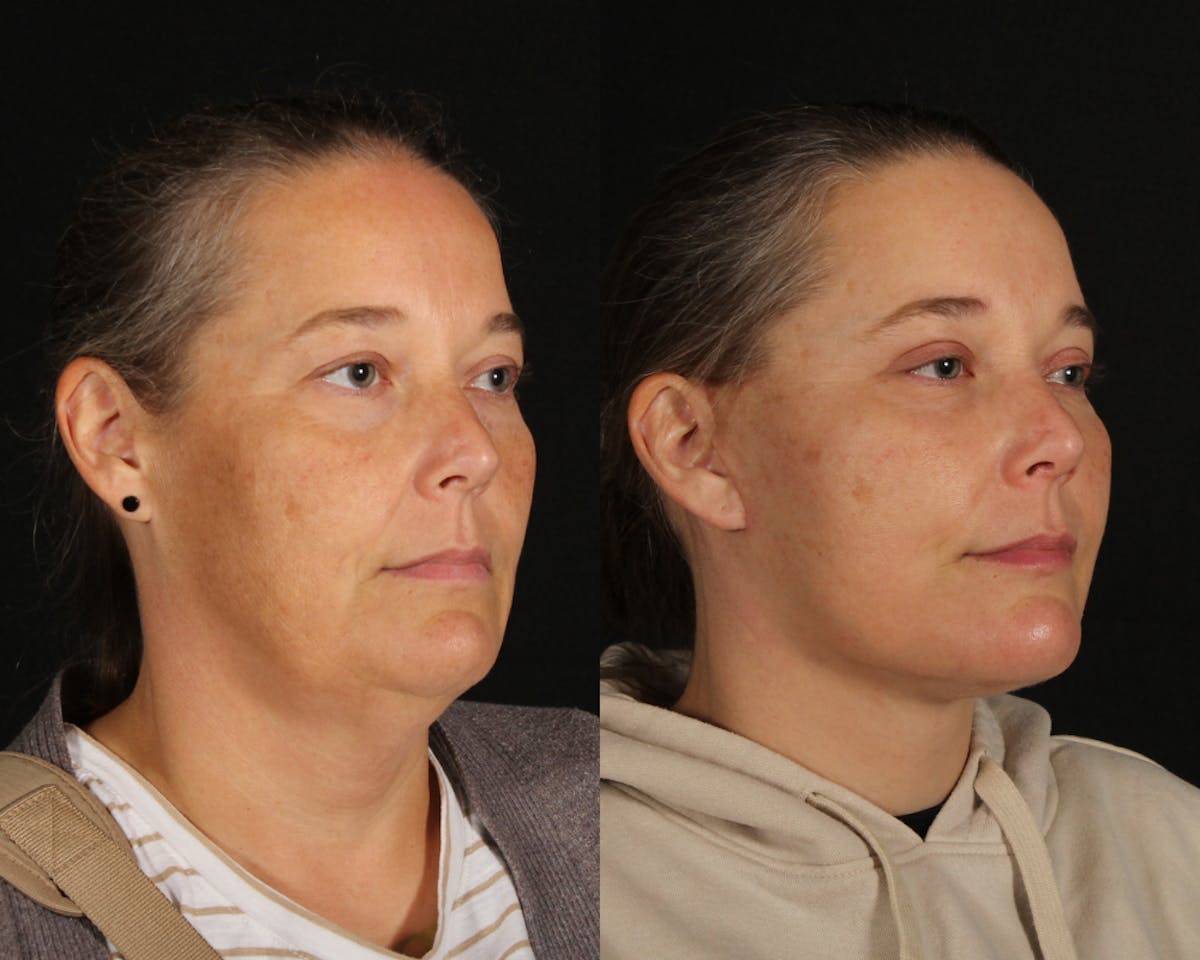 Face & Neck Lift Before & After Gallery - Patient 106284 - Image 2