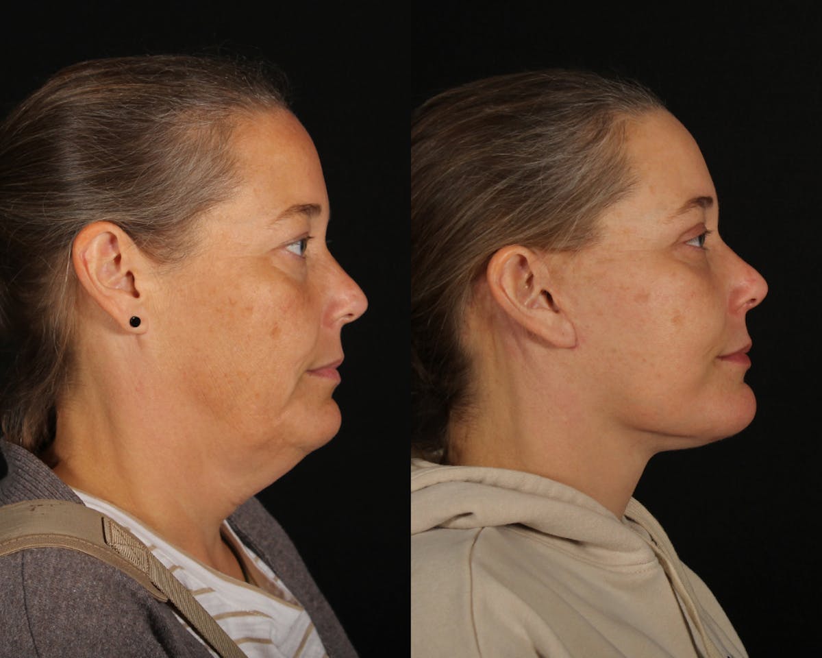 Face & Neck Lift Before & After Gallery - Patient 106284 - Image 3