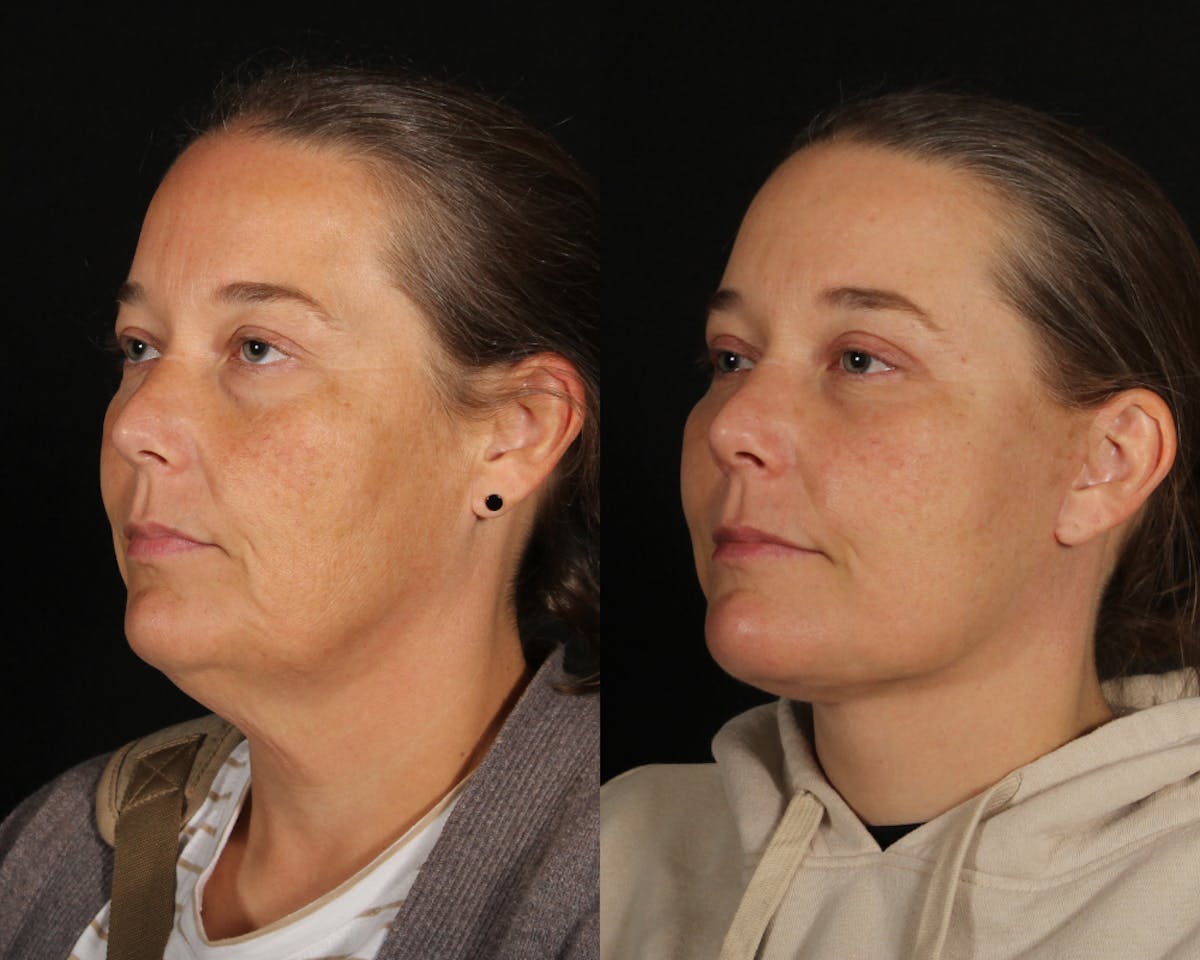 Face & Neck Lift Before & After Gallery - Patient 106284 - Image 4