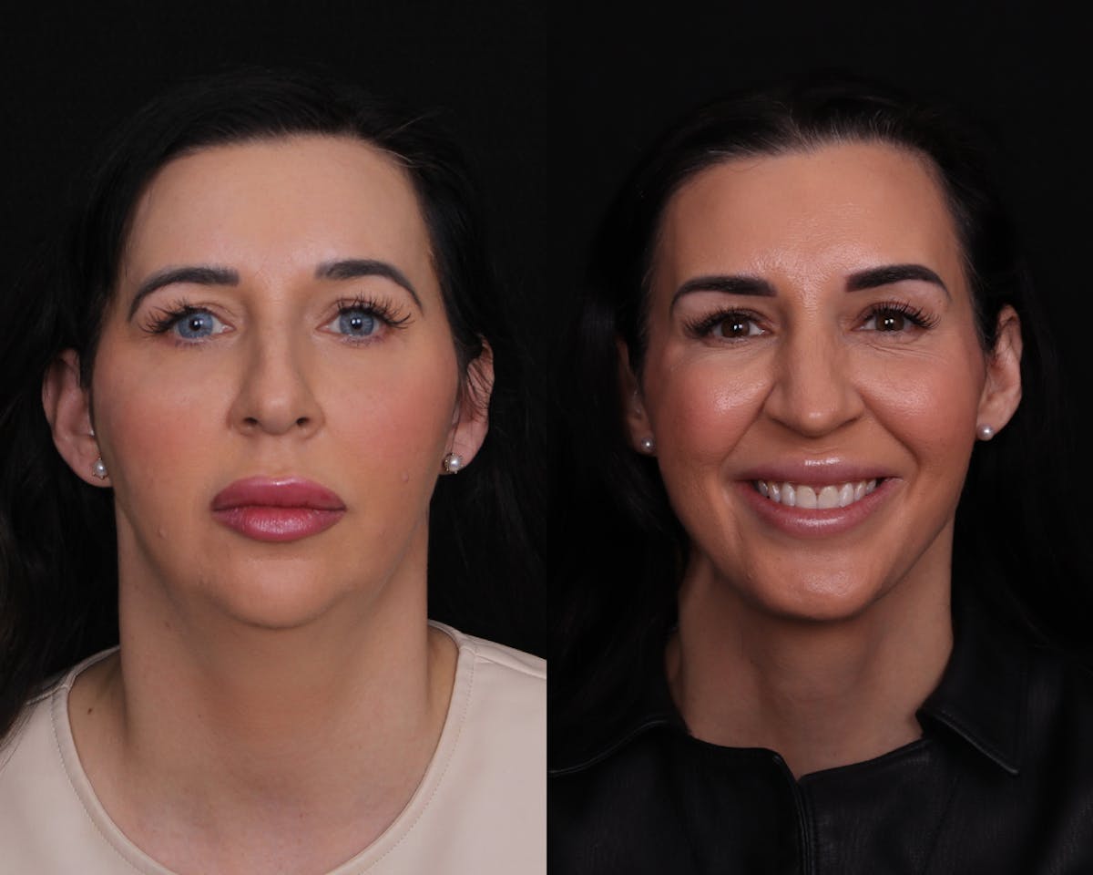 Face & Neck Lift Before & After Gallery - Patient 650370 - Image 1