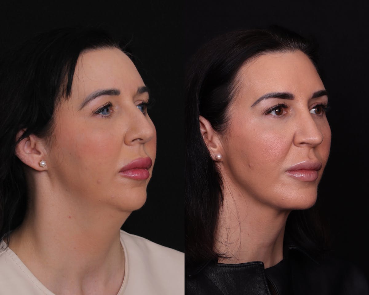 Face & Neck Lift Before & After Gallery - Patient 650370 - Image 2