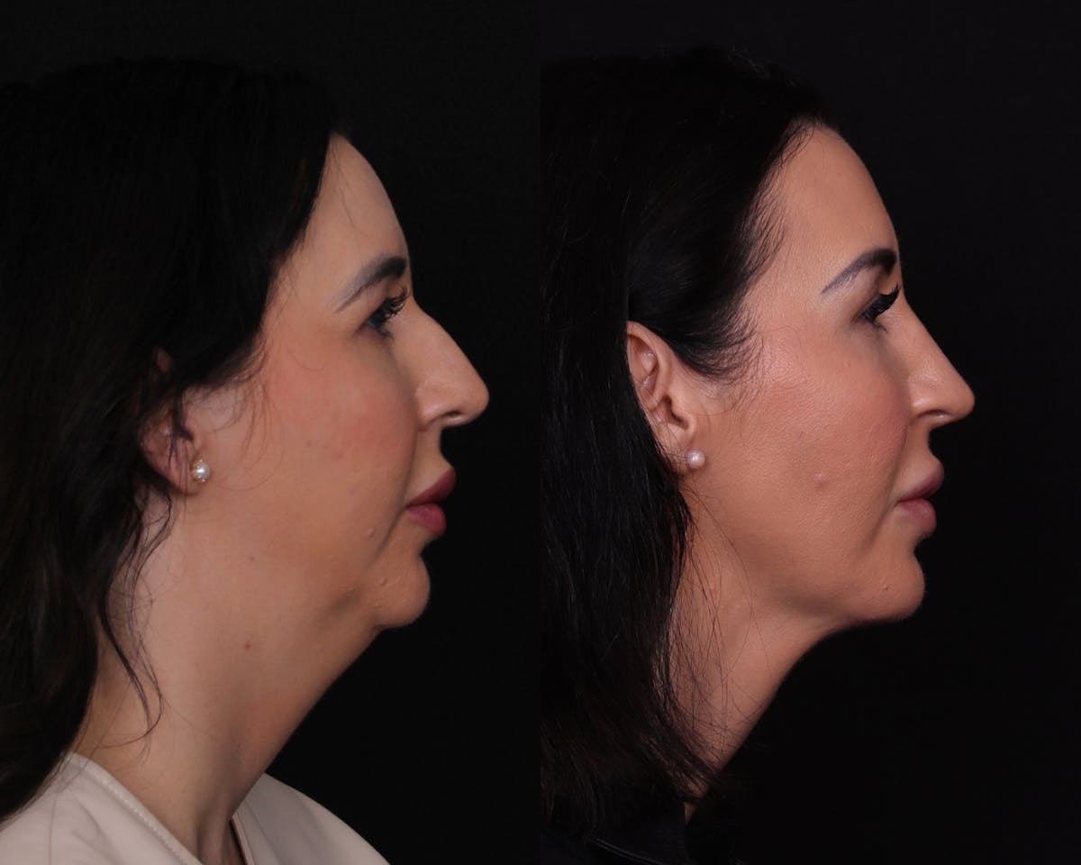 Face & Neck Lift Before & After Gallery - Patient 650370 - Image 3