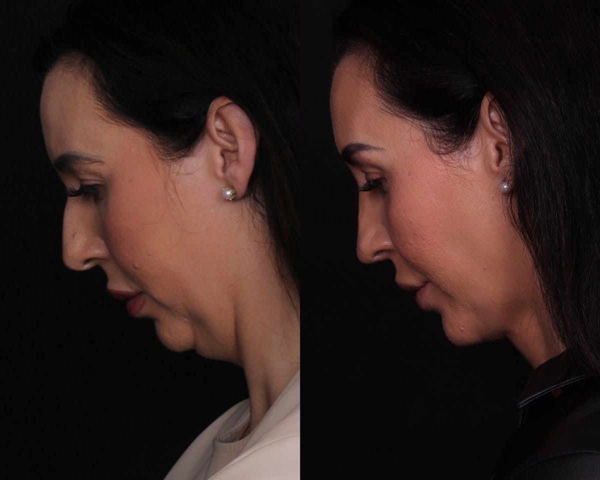 Face & Neck Lift Before & After Gallery - Patient 650370 - Image 6