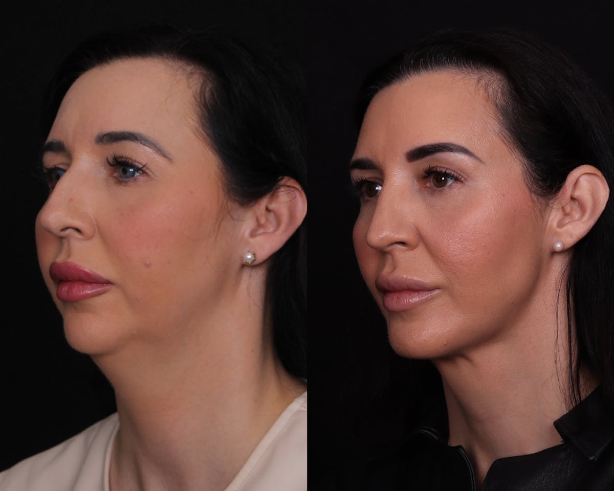 Face & Neck Lift Before & After Gallery - Patient 650370 - Image 4