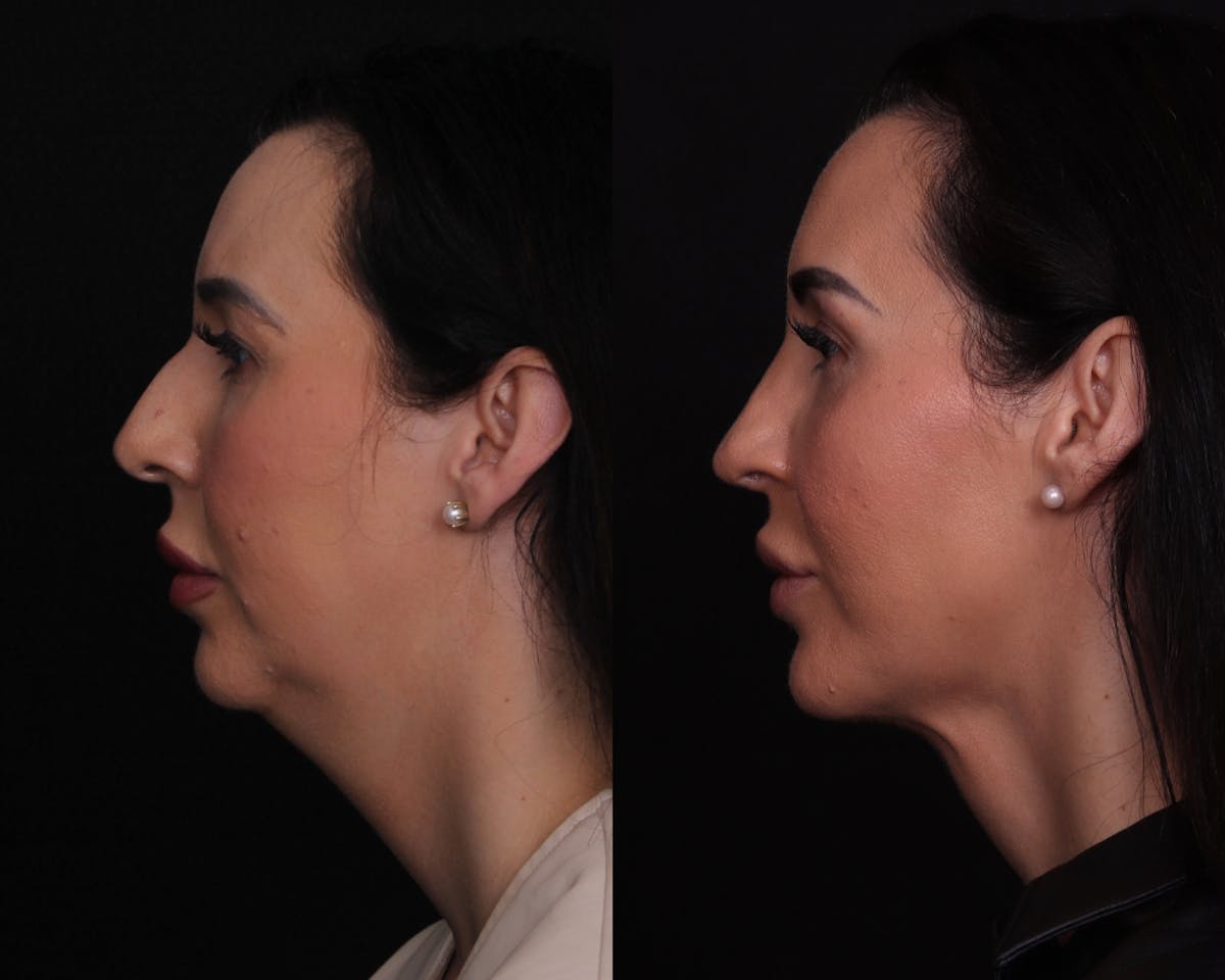 Face & Neck Lift Before & After Gallery - Patient 650370 - Image 5