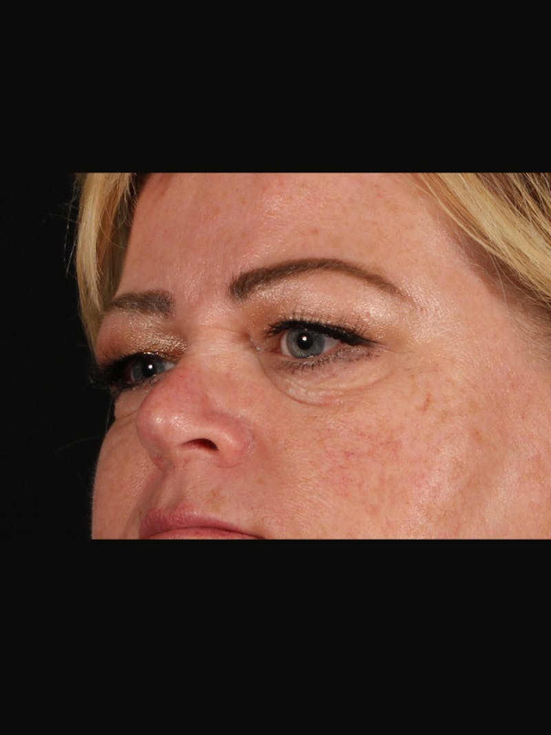 Blepharoplasty Before & After Gallery - Patient 188995 - Image 5