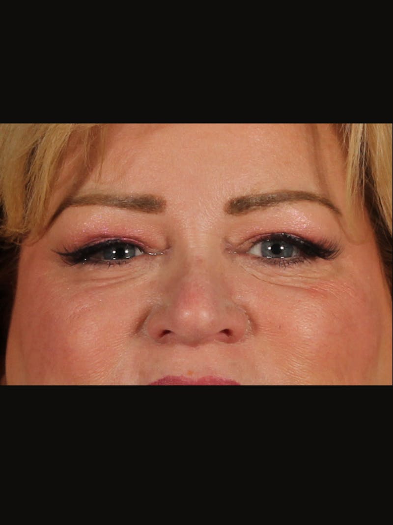 Blepharoplasty Before & After Gallery - Patient 188995 - Image 2