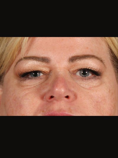 Blepharoplasty Before & After Gallery - Patient 188995 - Image 1