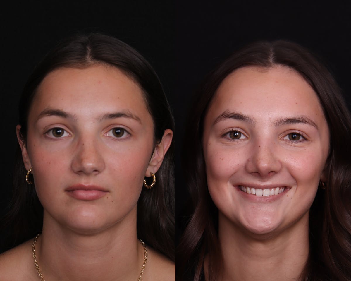 Rhinoplasty Female Before & After Gallery - Patient 248136 - Image 5