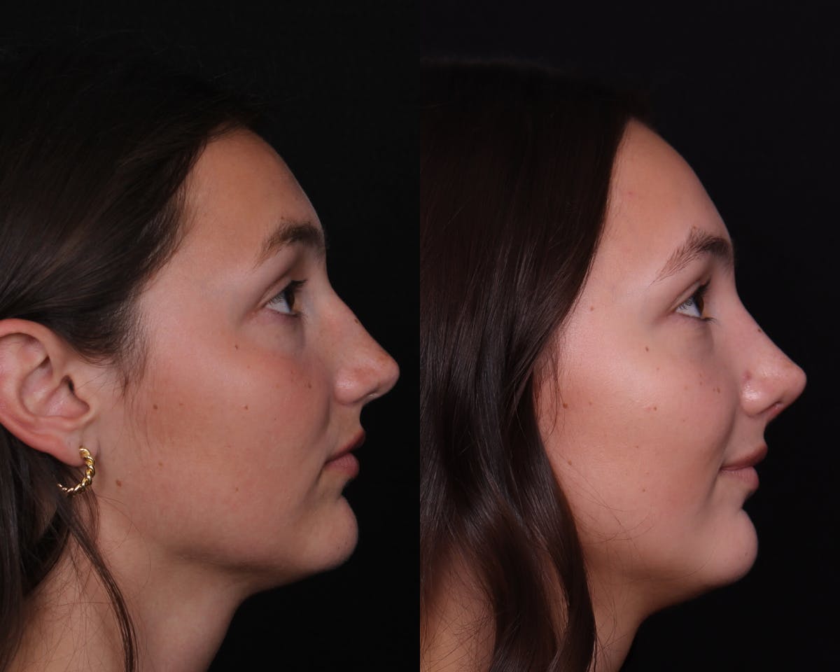 Rhinoplasty Female Before & After Gallery - Patient 248136 - Image 1
