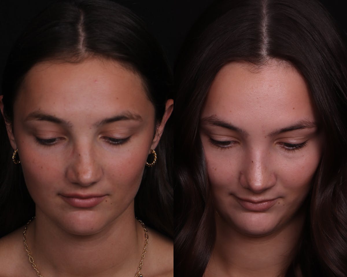 Rhinoplasty Female Before & After Gallery - Patient 248136 - Image 4