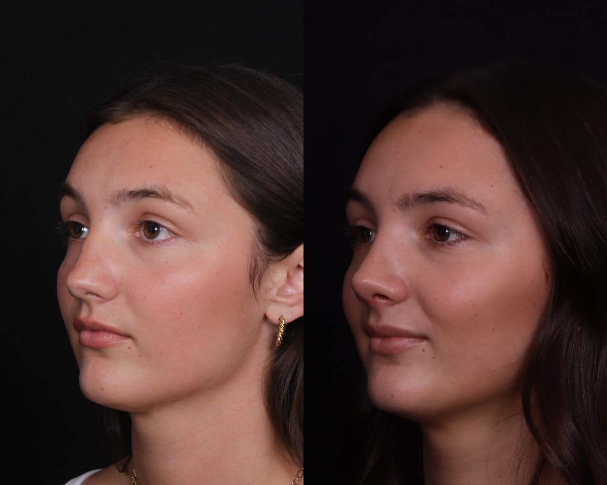Rhinoplasty Female Before & After Gallery - Patient 248136 - Image 2
