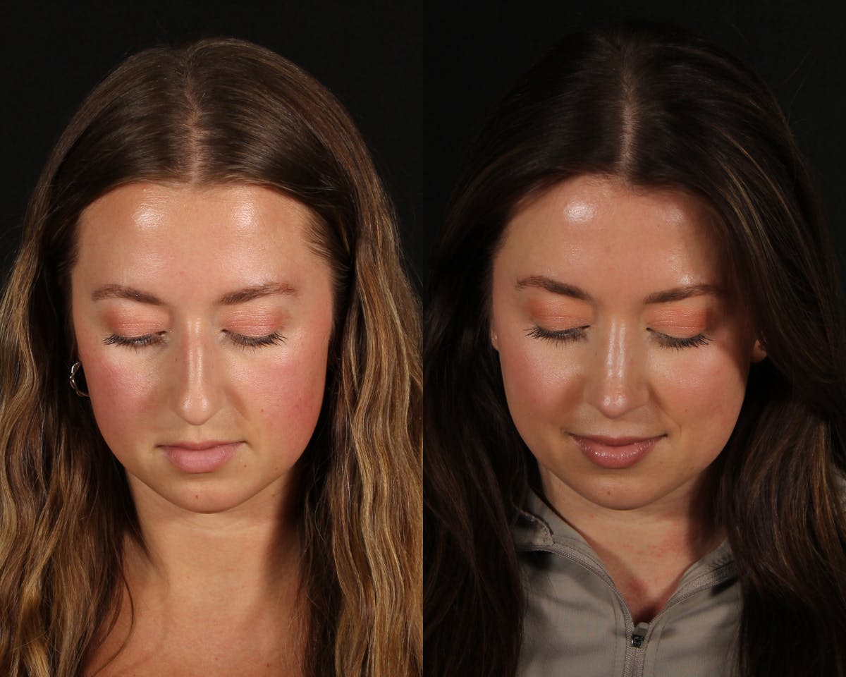 Rhinoplasty Female Before & After Gallery - Patient 408589 - Image 6