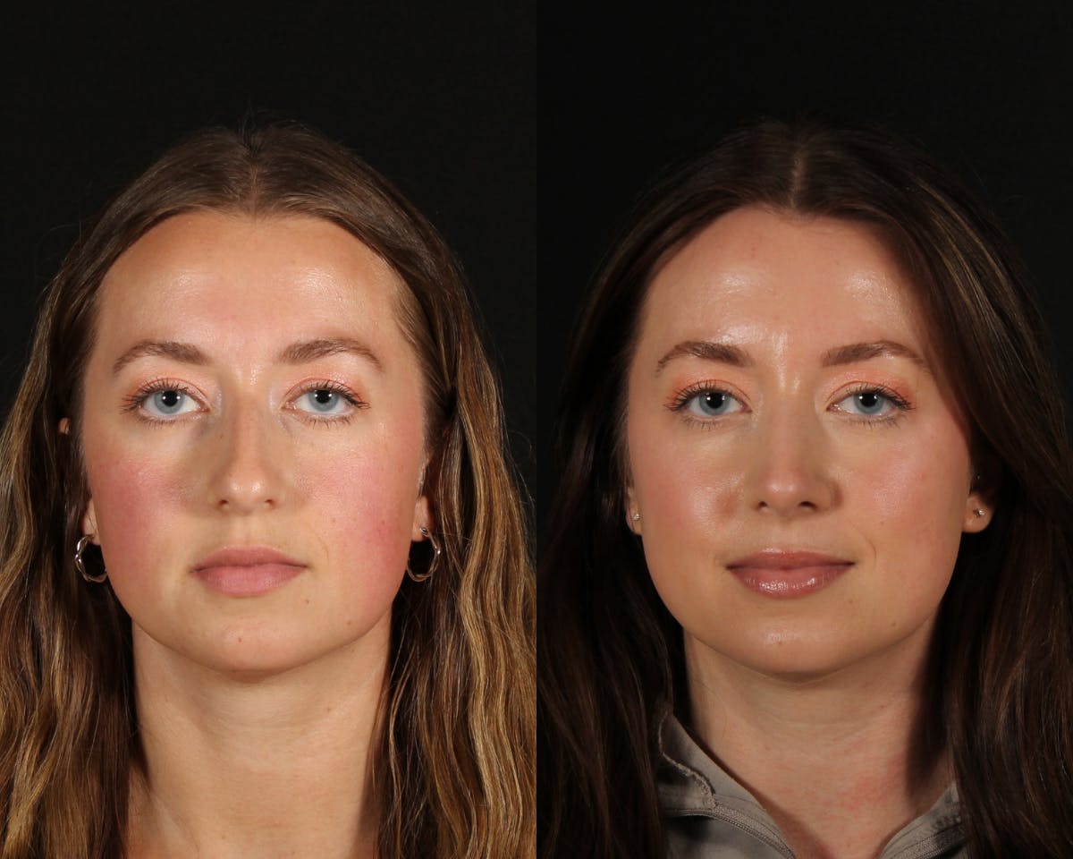Rhinoplasty Female Before & After Gallery - Patient 408589 - Image 3