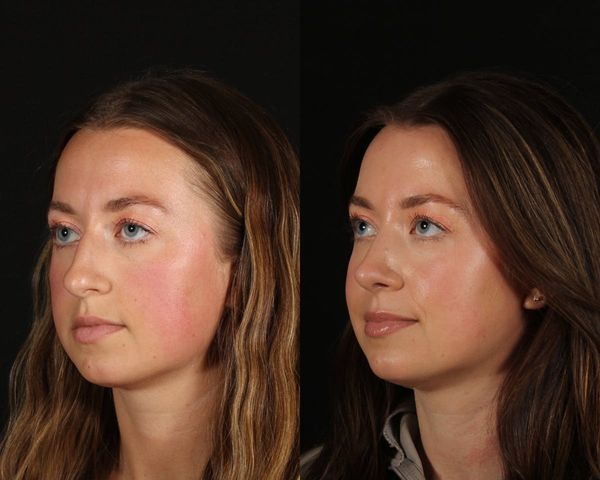 Rhinoplasty Female Before & After Gallery - Patient 408589 - Image 2