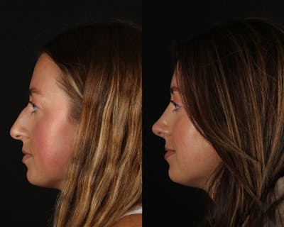 Rhinoplasty Female Before & After Gallery - Patient 408589 - Image 1