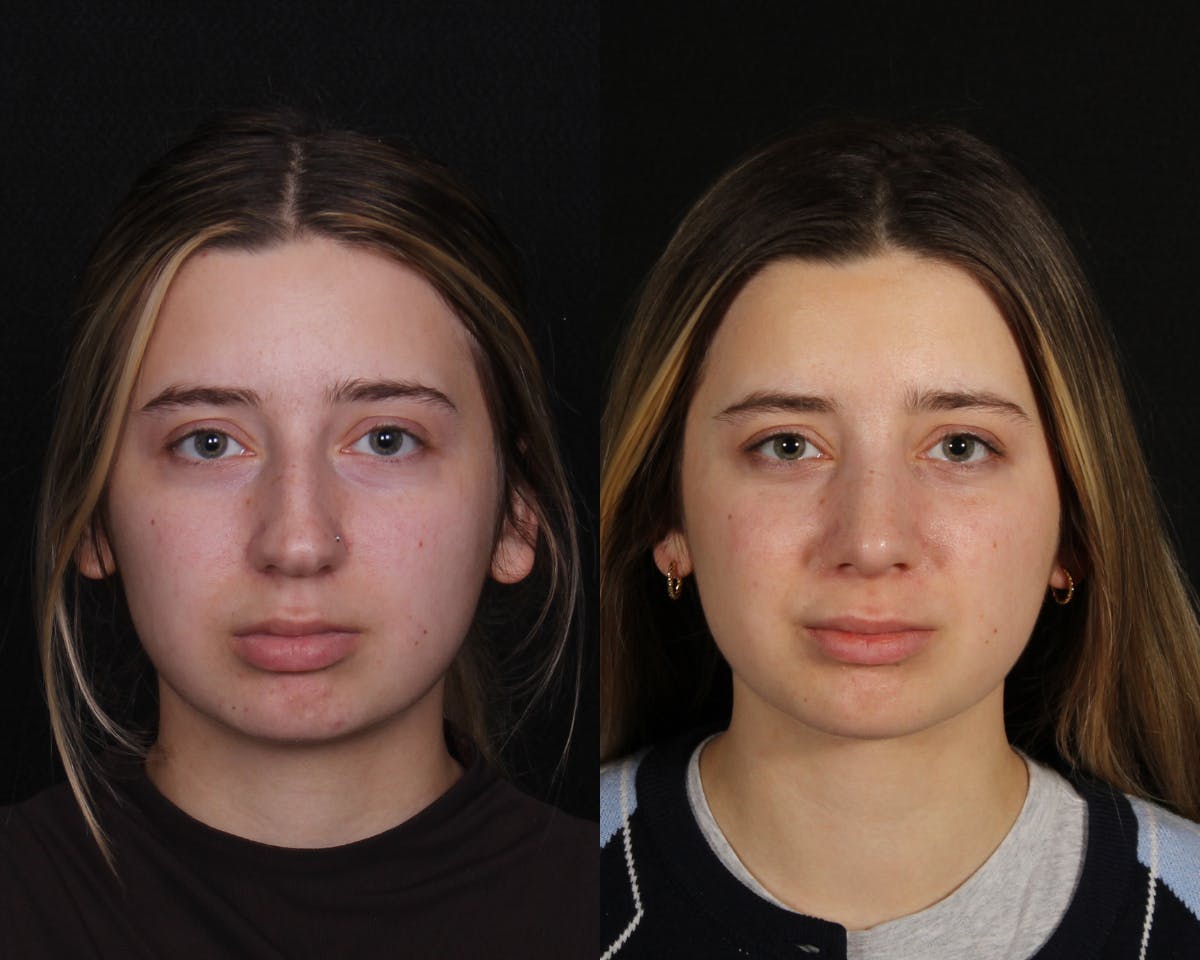 Rhinoplasty Female Before & After Gallery - Patient 403580 - Image 3
