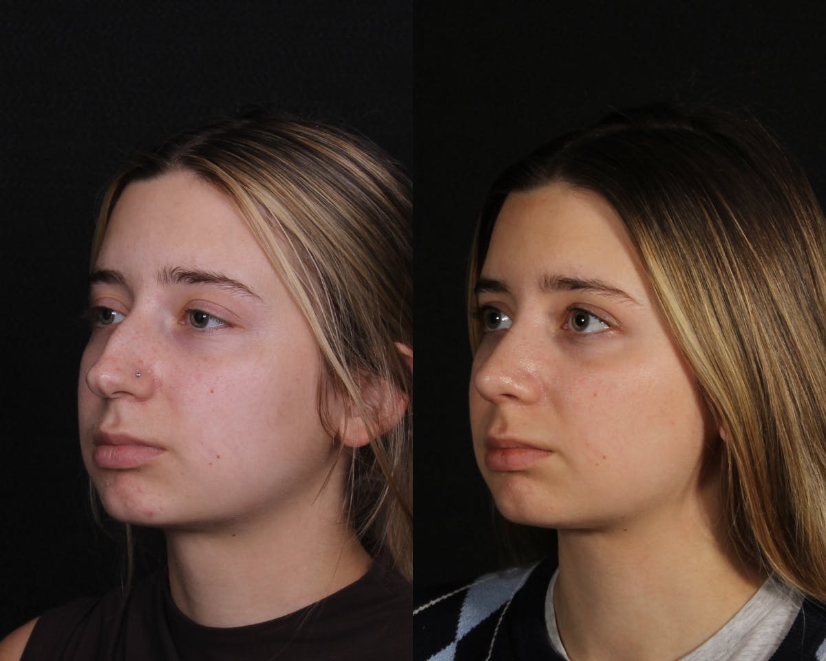 Rhinoplasty Female Before & After Gallery - Patient 403580 - Image 4