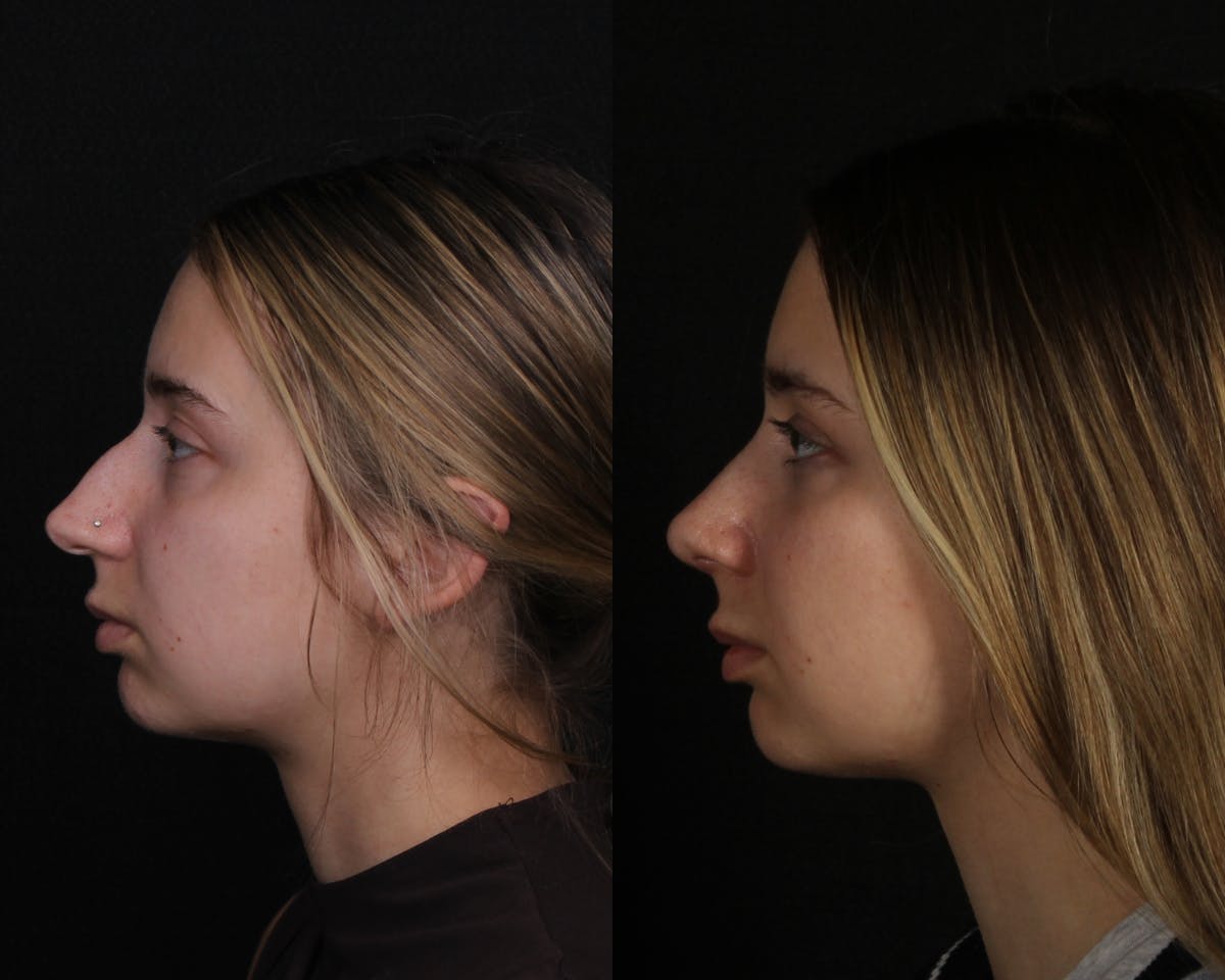 Rhinoplasty Female Before & After Gallery - Patient 403580 - Image 5