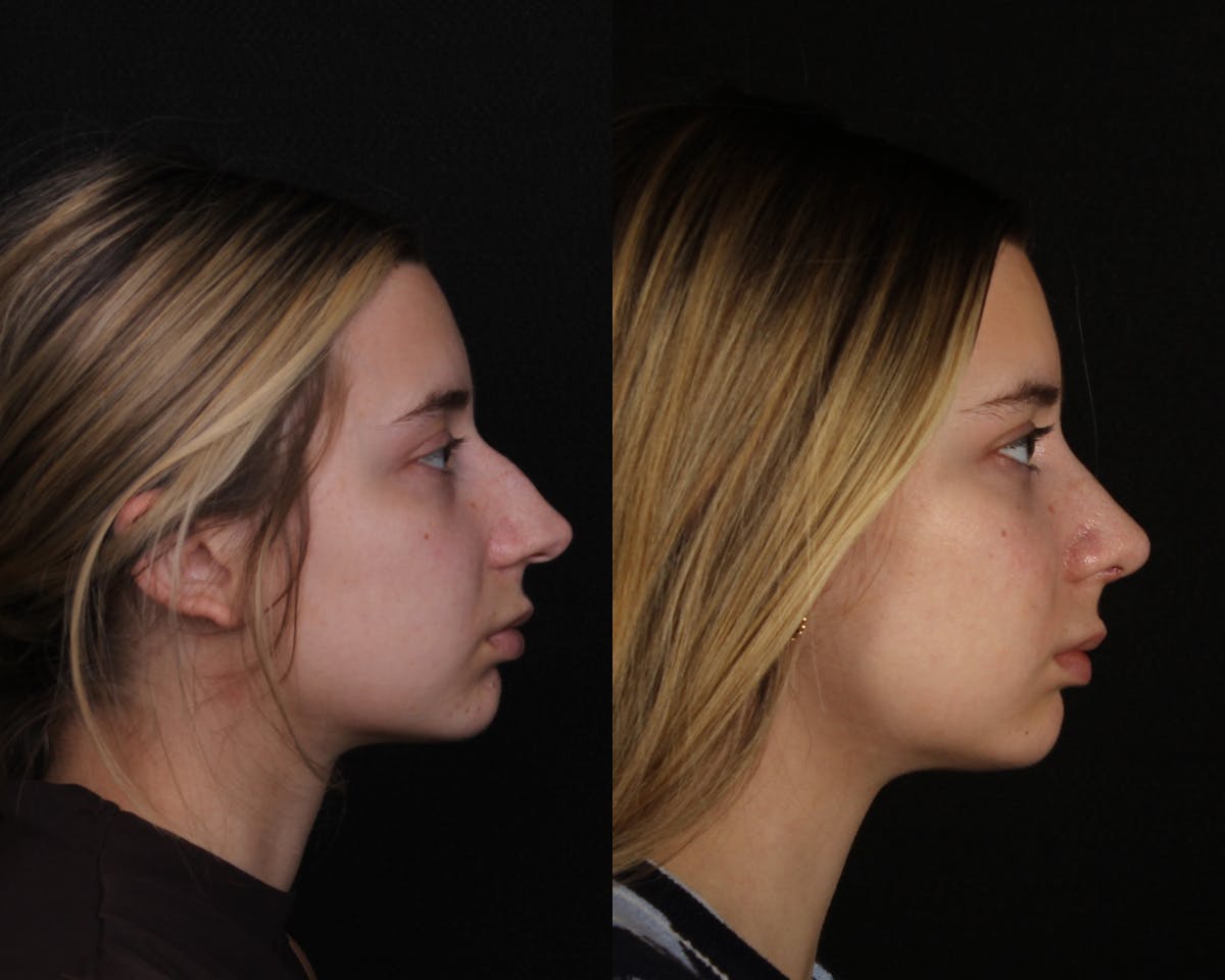 Rhinoplasty Female Before & After Gallery - Patient 403580 - Image 1