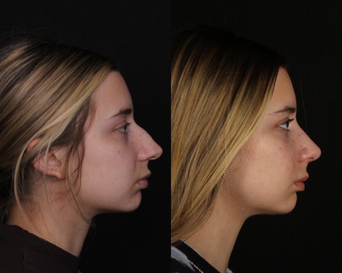 Rhinoplasty Female Before & After Gallery - Patient 403580 - Image 1