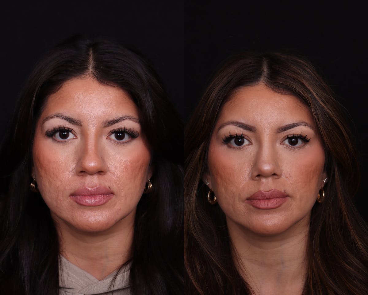 Rhinoplasty Female Before & After Gallery - Patient 402931 - Image 3