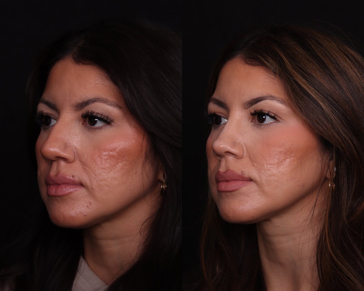 Rhinoplasty Female Before & After Gallery - Patient 402931 - Image 4