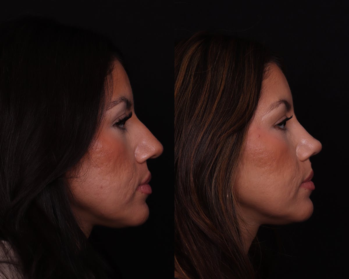 Rhinoplasty Female Before & After Gallery - Patient 402931 - Image 1