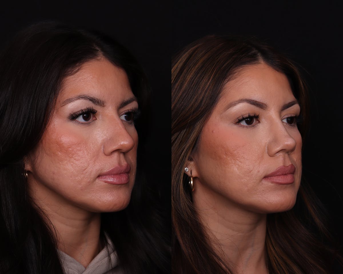 Rhinoplasty Female Before & After Gallery - Patient 402931 - Image 2