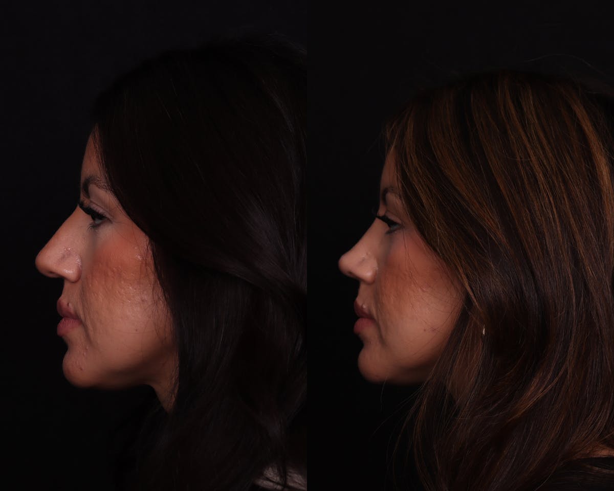 Rhinoplasty Female Before & After Gallery - Patient 402931 - Image 5