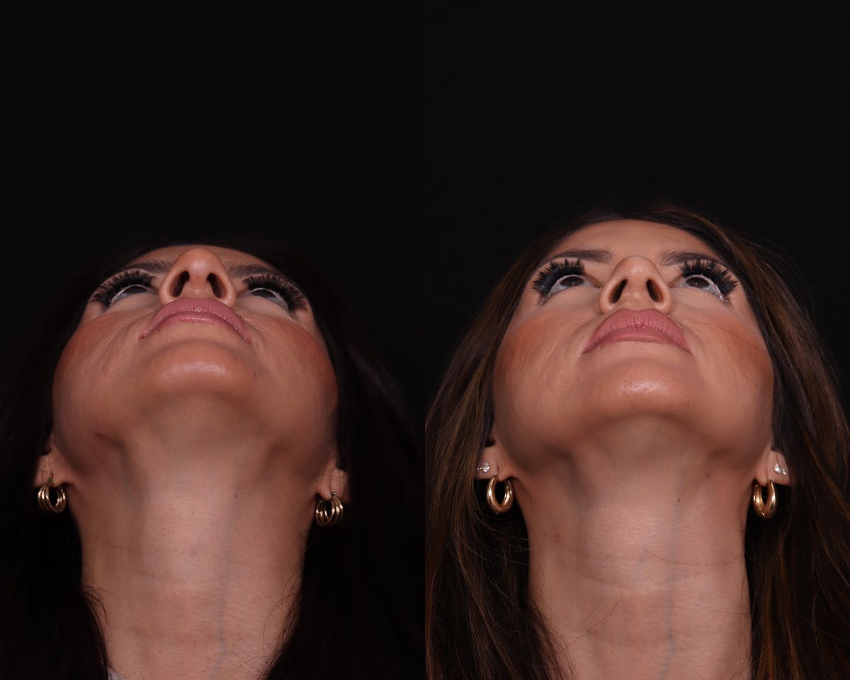 Rhinoplasty Female Before & After Gallery - Patient 402931 - Image 6