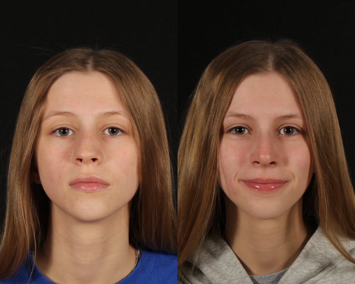 Rhinoplasty Female Before & After Gallery - Patient 191474 - Image 4