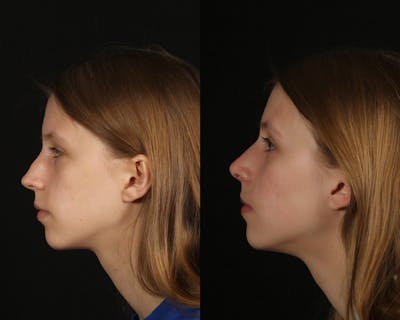Rhinoplasty Female Before & After Gallery - Patient 191474 - Image 1