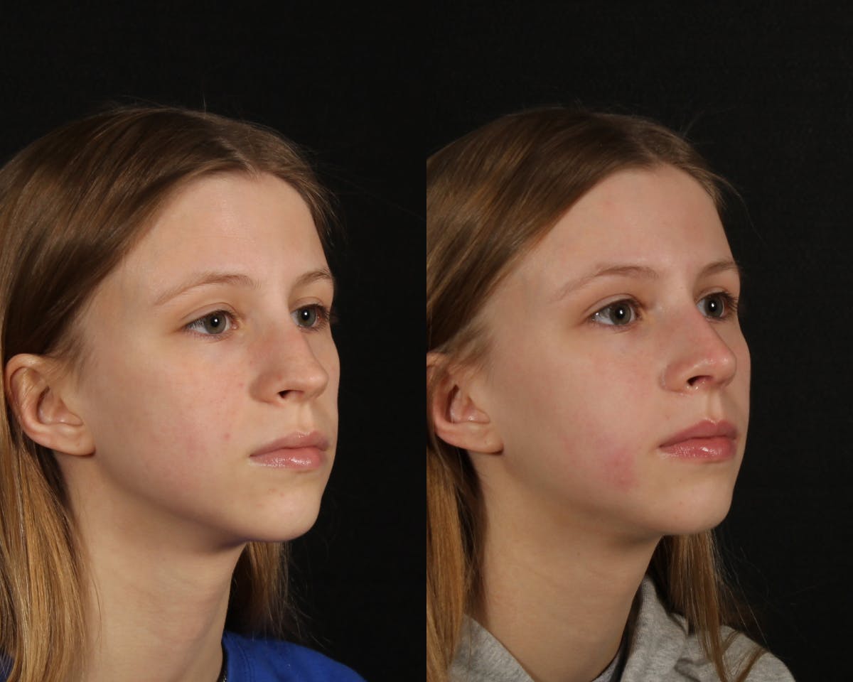 Rhinoplasty Female Before & After Gallery - Patient 191474 - Image 2