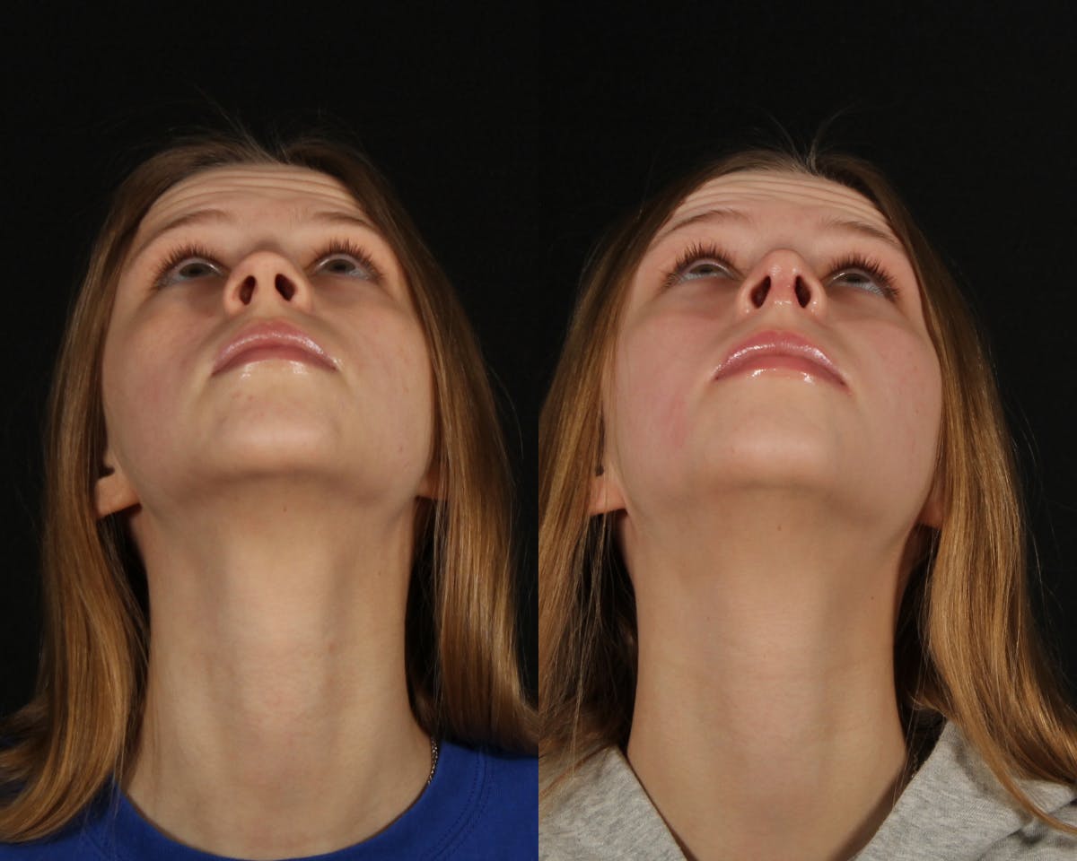 Rhinoplasty Female Before & After Gallery - Patient 191474 - Image 3