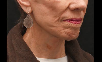 Facelift Before & After Gallery - Patient 241950 - Image 2