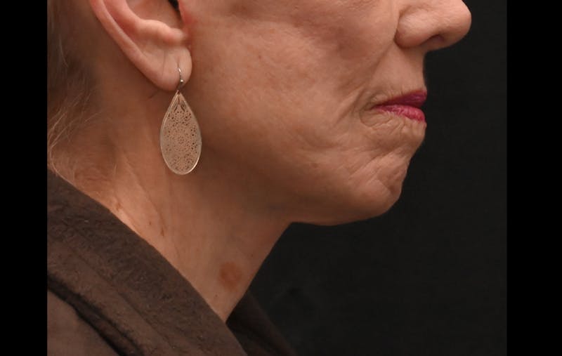 Facelift Before & After Gallery - Patient 241950 - Image 4