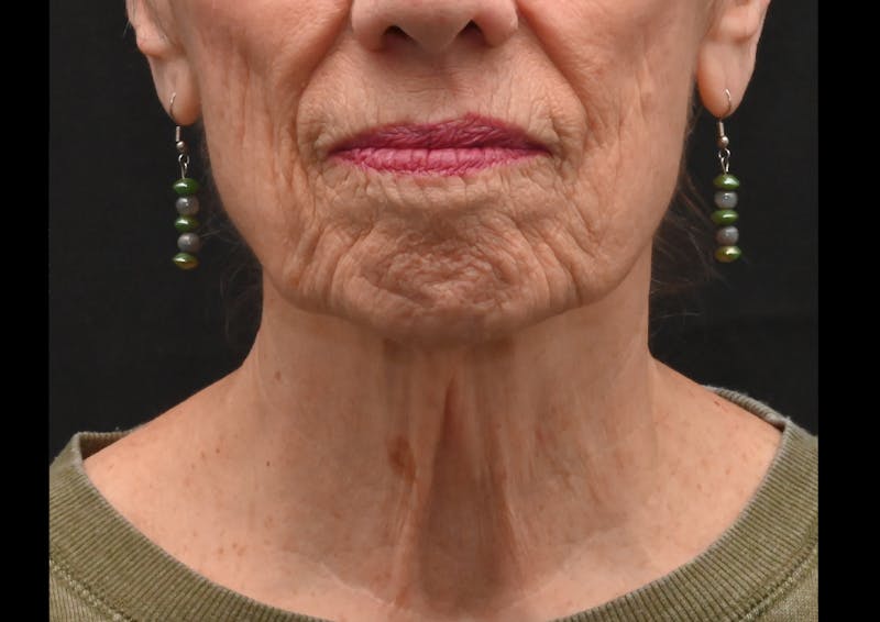 Facelift Before & After Gallery - Patient 241950 - Image 9