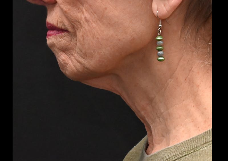 Facelift Before & After Gallery - Patient 241950 - Image 7