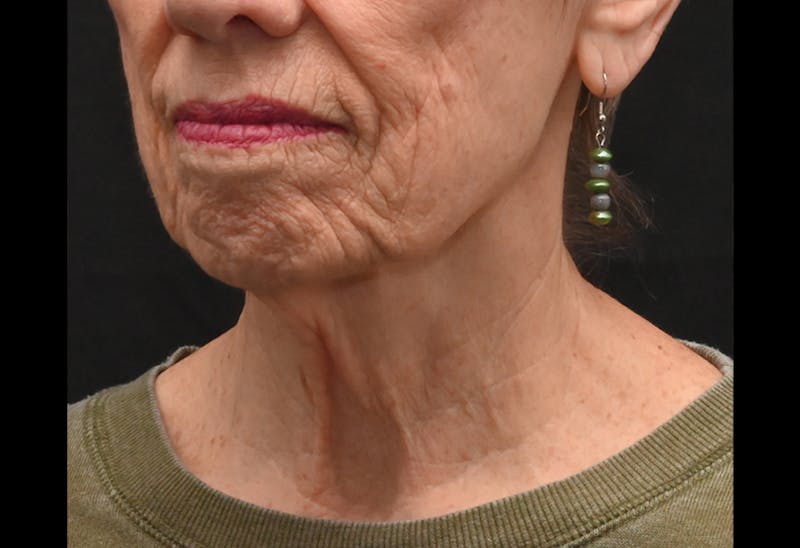 Facelift Before & After Gallery - Patient 241950 - Image 5