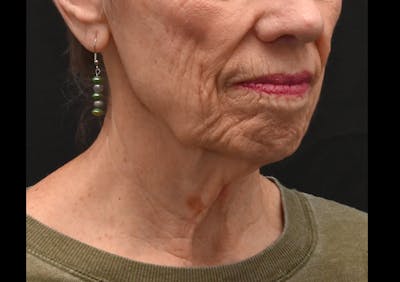 Facelift Before & After Gallery - Patient 241950 - Image 1
