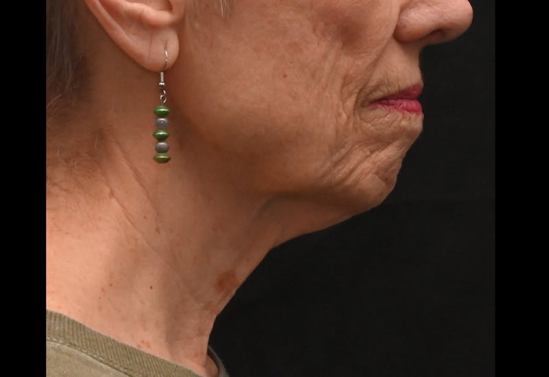 Facelift Before & After Gallery - Patient 241950 - Image 3