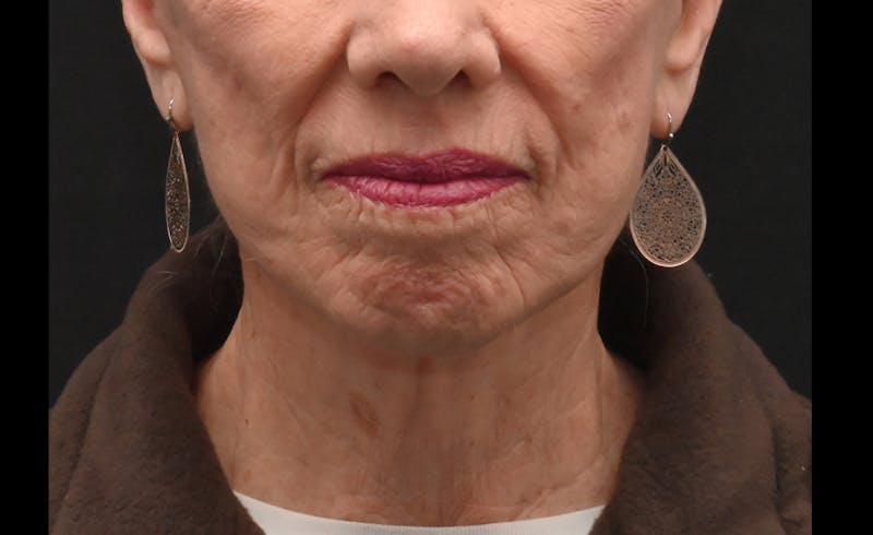Facelift Before & After Gallery - Patient 241950 - Image 10