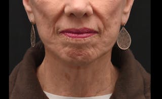 Deep Plane Facelift & Neck Lift Before & After Gallery - Patient 241950 - Image 10