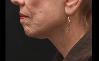 Deep Plane Facelift & Neck Lift Before & After Gallery - Patient 241950 - Image 8