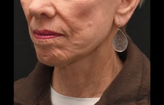 Deep Plane Facelift & Neck Lift Before & After Gallery - Patient 241950 - Image 6