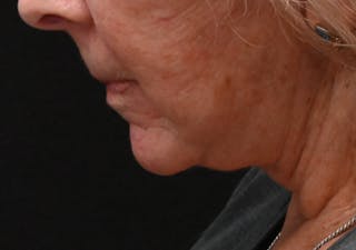 Deep Plane Facelift & Neck Lift Before & After Gallery - Patient 408229 - Image 10
