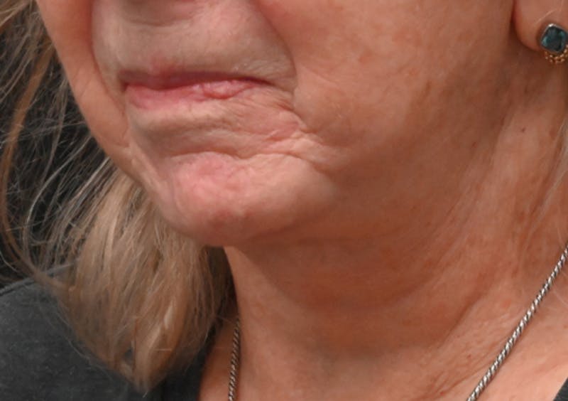 Facelift Before & After Gallery - Patient 408229 - Image 12
